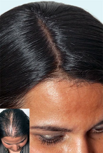 does scalp massage regrow hair